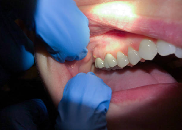 Best Dentist for Tooth Abscess  in Wahese, NC